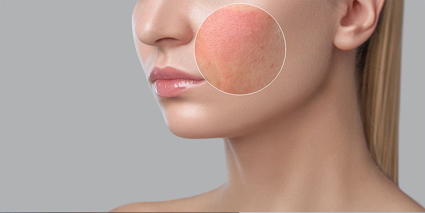 Alergias en la piel